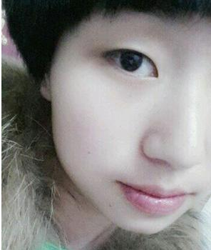 南京医科大学第二附属医院整形美容中心李昌医生割双眼皮案例:割 - 珍美网