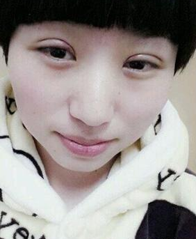 南京医科大学第二附属医院整形美容中心李昌医生割双眼皮案例:割 - 珍美网