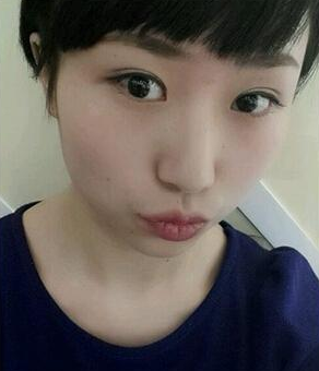 南京医科大学第二附属医院整形美容中心李昌医生割双眼皮案例：割