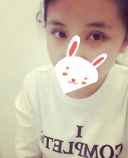 割双眼皮 觉得自己的气质也出众啦 - 珍美网