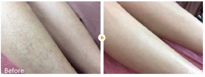半导体激光脱毛有什么效果