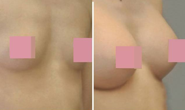 假体隆胸对比照 让我不再为胸部自卑了
