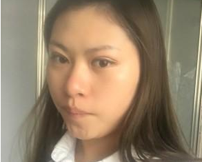 长春南关区铭妍医疗美容部庄璐医生割双眼皮案例：割双眼皮