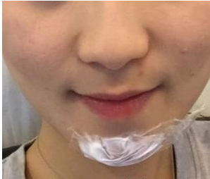 温州友好医院尹建祥医生垫下巴案例：细心记录我的玻尿酸丰下巴经 - 珍美网