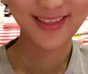 温州友好医院尹建祥医生垫下巴案例：细心记录我的玻尿酸丰下巴经