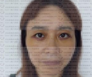 成都温江达拉斯整形美容诊所严新医生去眼袋案例：外切眼袋
