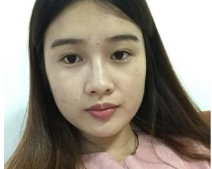 深圳晨曦医疗美容门诊部朱春艳医生瘦脸案例：瘦脸针