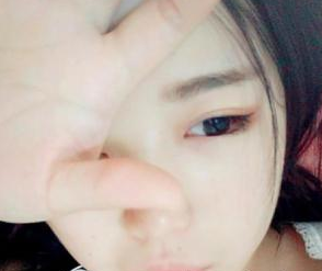 北京叶美人医疗美容诊所余森林医生割双眼皮案例：人都夸我美美了