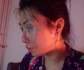 面部填充 美丽离我也不是很远