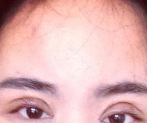 割双眼皮 实现美的不一样的自己