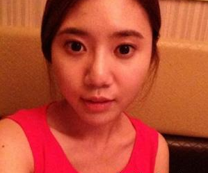 玻尿酸隆鼻 效果好看的让我想要拥有长久性的美鼻 - 珍美网