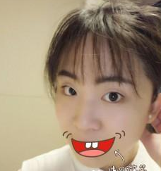 双眼皮手术  面部整体看起来美腻好多啊 - 珍美网