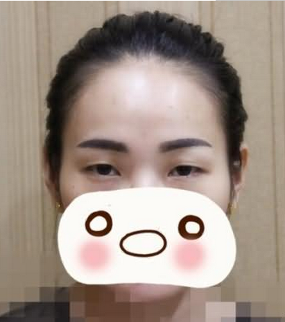 割双眼皮手术  让我重新感受到我的不一样的美丽 - 珍美网