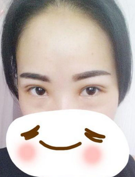 割双眼皮手术  让我重新感受到我的不一样的美丽