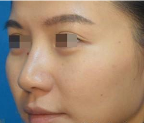 肉毒素去鱼尾纹 让我笑起来还是美丽动人