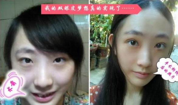 双眼皮手术 小眼变大眼真的美出一个境界
