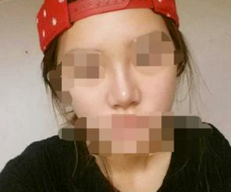 隆鼻手术整形  丑鼻也能实现分分钟美丽侧颜