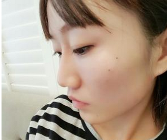 玻尿酸面部填充  快速告别苍老的现象实现活力美的自己