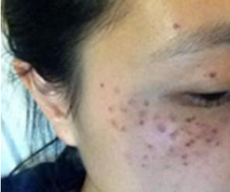 激光祛斑 让我拥有白嫩肌肤 - 珍美网