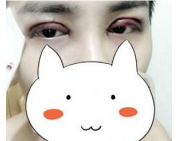 郑州丽天医疗美容门诊部陈红燕医生割双眼皮案例：割双眼皮+开眼