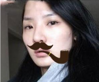 玻尿酸多部位面部填充  重现年轻美貌精致的自己