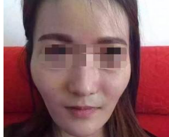 自体脂肪面部填充 焕然一新  - 珍美网