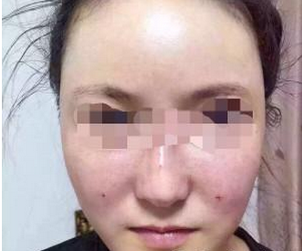 自体脂肪面部填充 焕然一新