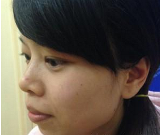 玻尿酸隆下巴 脸部变得柔和让我更加美丽 - 珍美网