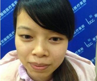 玻尿酸隆下巴 脸部变得柔和让我更加美丽 - 珍美网