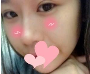 微创双眼皮手术 让我眼睛更加美丽动人 - 珍美网