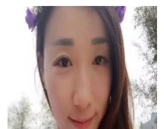 丰全脸手术 让我胶原蛋白满满光彩照人 - 珍美网