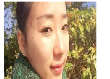 丰全脸手术 让我胶原蛋白满满光彩照人 - 珍美网