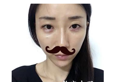 丰全脸手术 让我胶原蛋白满满光彩照人 - 珍美网