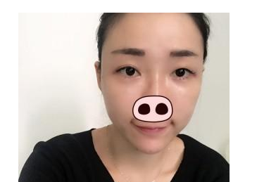 丰全脸手术 让我胶原蛋白满满光彩照人 - 珍美网