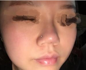 玻尿酸注射隆鼻  让我找回美丽的自信