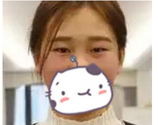 割双眼皮手术  让我脸部更加美丽动人 - 珍美网