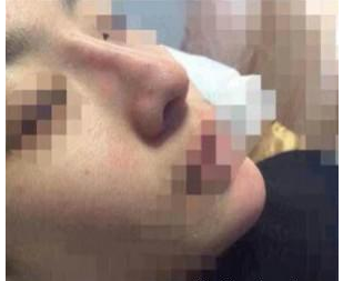 玻尿酸隆鼻 塌鼻变高挺美鼻分分钟美出境界