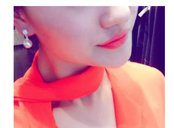 玻尿酸丰下巴  让我感受美丽的滋味