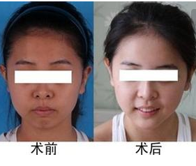 注射美白针的效果好不好