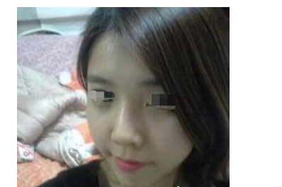 玻尿酸隆鼻  完美的鼻子值得拥有 - 珍美网