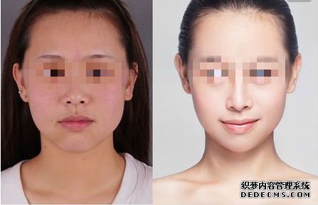 光子嫩肤手术多少钱