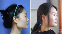 削下颌骨北京张笑天和上海俞良钢那个好？