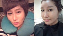 自体脂肪填充王明利和王志军哪个好？