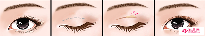 成都赵善军博士整形切开法双眼皮