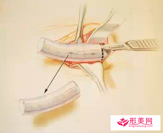 做自体软骨隆鼻后多久能正常上班