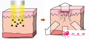 激光祛黄褐斑要多少次