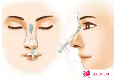 玻尿酸隆鼻多久要补打一次