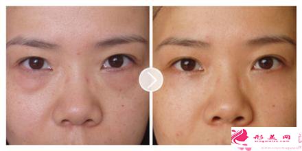 做完眼袋应该怎么护理_眼袋手术做完后怎么保养?