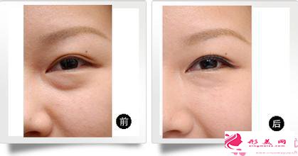 做完眼袋应该怎么护理_眼袋手术做完后怎么保养?