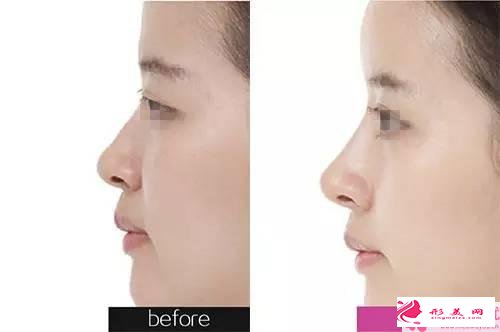 固体硅胶隆鼻的优点_固体硅胶隆鼻有哪些优点?